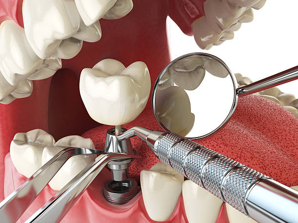 Best Dental Abscess Treatment in Georgetown, CO